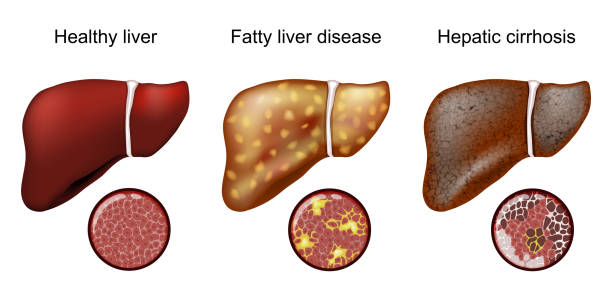 Using GLP-1 medications as NAFLD treatment