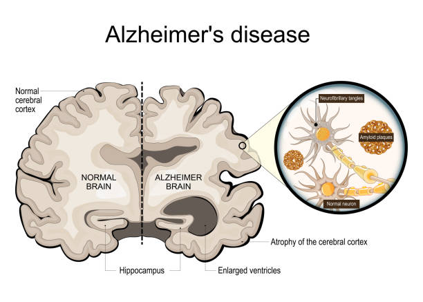 Neurodegeneration