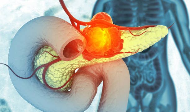 inflammation of the pancreas